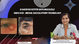 R DACRYOCYSTITIS WITH MUCOCELEENDO DCR  MEDIAL SACCULOTOMY TECHNOLOGY DRSHAKUNTALA GHOSH [upl. by Kiyohara]