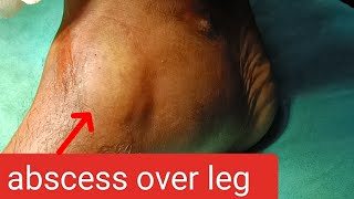 abscess over leg  incision n drainage youtube dr doctor [upl. by Zeuqcaj]