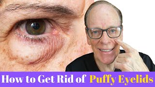 How to Get Rid of Puffy Eyelids  Plastic Surgeon Insight [upl. by Ermina]