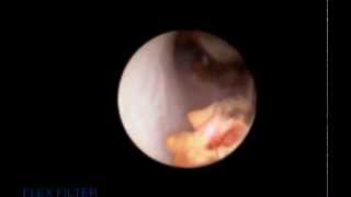 Ureteroscopy and laser fragmentation of stone [upl. by Anoel138]