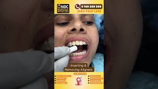 Aligner Tips  Inserting And Removing Aligners safely  Best Dental Hospital In Hyderabad  NDC [upl. by Kellyn]