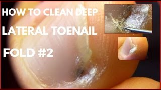 How to clean Deep lateral toenail fold 2 [upl. by Yttiy95]