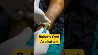 Baker’s Cyst aspiration knee joint swelling opd procedure cyst [upl. by Lorre551]