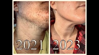 144 Hours of Electrolysis Hair Removal  Before and After Pics amp Footage  PCOS  Hirsutism Support [upl. by Siravrat611]