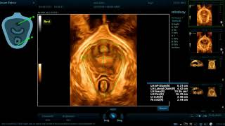 Auto Valoración ecográfica del suelo pelvico por 3D [upl. by Nnylrahc]