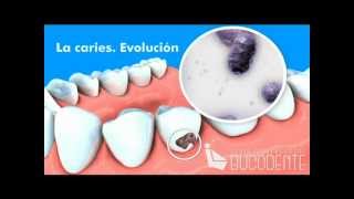 Bucodente Evolución de la caries [upl. by Madson]