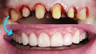 Front Tooth Crowns Before amp After Cosmetic Dentist Smile Makeover EMAX Preparation Remove Veneers [upl. by Courtland520]