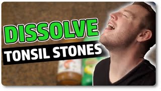 Dissolve Tonsil Stones At Home With Only 3 Ingredients [upl. by Rochette35]