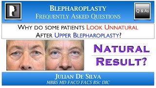 Why do some patients Look UNNATURAL after Upper Blepharoplasty [upl. by Jedlicka]