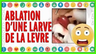 ablation  extraction  dune larve de la lèvre [upl. by Sarena503]