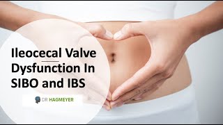 Healing The Ileocecal Valve amp Why Its Important In SIBOIBS [upl. by Menendez]