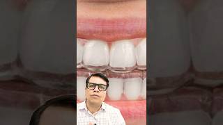 How Painful is aligners youtubeshorts shortvideo shorts short aligners [upl. by Madra]