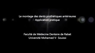 Montage des dents prothétiques antérieures [upl. by Yrtnej772]