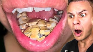 Orthodontist Reacts To Disgusting Teeth Cleanings [upl. by Alva]