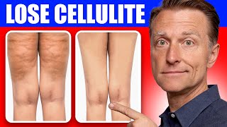 Get Rid of Cellulite for Good Dr Bergs Better Way to Lose Flabby Fat [upl. by Oigroeg]