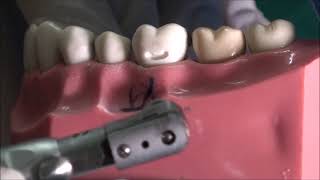 Class V cavity preparation and Glass Ionomer Cement Restoration [upl. by Dryden]