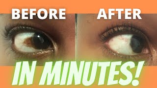 How to get rid of brown spot on eye Discolouration Pigment  Freckle Pterygium Conjunctival Nevus [upl. by Aruon]