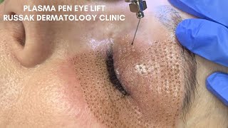 Dark Eye Circles Treatment Eye Rejuvenation amp Lift  EndyMed iFine [upl. by Azaria]