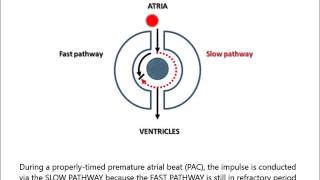 AV Nodal Reentry Tachycardia AVNRT for noncardiologist in less than 2 minutes [upl. by Airret255]