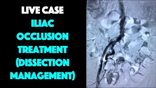 Live Case Aortoiliac Intervention with Dissection Management Discussion [upl. by Aznecniv13]