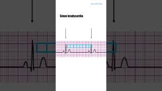 ECG Sinus bradycardia concept for neetpg Inicet Fmge Next mbbs and nextfellow [upl. by Eelrak803]