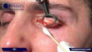 Stye No More Revolutionary Removal Technique [upl. by Mathews]