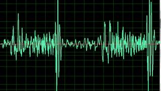 Mitral Regurgitation Tricuspid Regurgitation slow [upl. by Jenny]