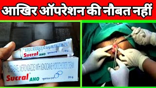 Sucral ANO Cream uses in Hindi  अगर आपको बवासीर हो गए हैं तो ये इस्तेमाल करे [upl. by Spalla116]