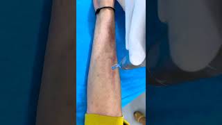 Laser treatment for lichen Planus Pigmentosus Treatment  Skinaa Clinic viral viralshort [upl. by Roley]