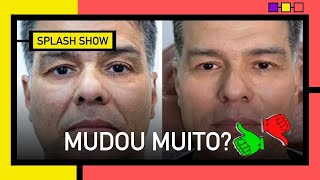 Antes e depois Maurício Mattar faz harmonização facial Aprovado [upl. by Enamrahc758]