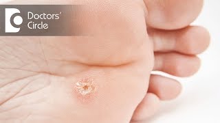 Causes amp management of Corns amp Calluses  Dr Rashmi Ravindra [upl. by Yenmor]