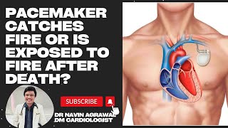 The Risk of Pacemaker Fires What Happens When Things Get Hot 🔥 MustWatch [upl. by Houghton]