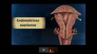 LENDOMETRIOSE  WEBINAR ECHOGRAPHIE GYNECOLOGIQUE [upl. by Janerich]