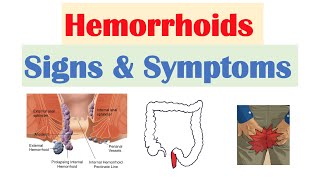 Hemorrhoids Signs amp Symptoms  Internal vs External Hemorrhoid Symptoms  Hemorrhoidal Disease [upl. by Goody515]