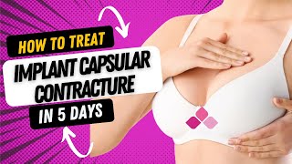 How to treat breast implant capsular contracture in 5 days [upl. by Refotsirc]