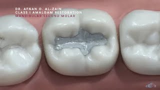 Class I amalgam restoration – Mandibular molar 47  Arabic عربي [upl. by Eirrab]