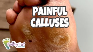 CALLUS REMOVAL AT HOME SO SATISFYING [upl. by Darian]