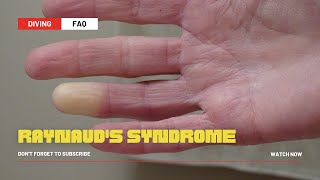 Raynauds Syndrome [upl. by Anitac511]