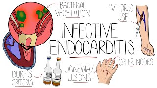 Infective Endocarditis With Duke Criteria amp Pathophysiology [upl. by Nohsad]