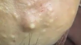 LARGE Blackheads Removal  Satisfying Blackhead 2019 [upl. by Euqirne604]