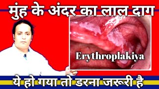 Is erythroplakia a cancer what are the symptoms of erythoplakia DrAmitkrDubey [upl. by Lilia]