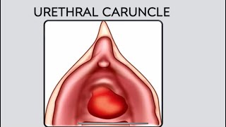 Urethral caruncle DefinitionPathogenesisClinical Features Differential Diagnosis and Treatment [upl. by Garris]