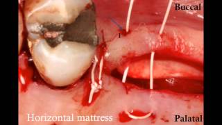 How to suture a large flap a SurgicalMaster Instant Replay [upl. by Anallese140]