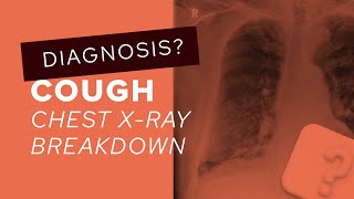 Chest XRay breakdown assessing a film with pleural plaques [upl. by Mellar]