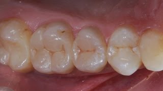 Реставрация и эндодонтическое лечение боковых зубов Resto amp Endo of posterior teeth [upl. by Coyle]