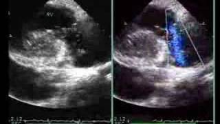 TRICUSPID VALVE PROLAPSE [upl. by Bayly]