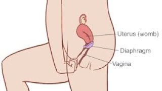 Diaphragm The Hidden Secret to HormoneFree Birth Control [upl. by Myrvyn]