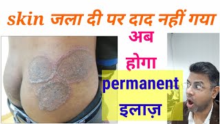 Fungal infection permanent treatment I Daad ka ilaj l Skin Care Clinic l Dr ANIL MOHITE l MD [upl. by Lanita855]