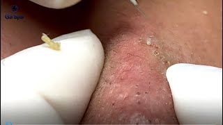 If You Like Squeezing Acnes Youll Must be See This Video  Full 33 Minutes  GaSpa 18032022 [upl. by Ssalguod]