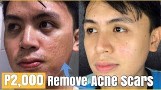 HOW TO REMOVE ACNE SCARS  P2000 FRACTIONAL LASER PAANO KUMINIS [upl. by Sand383]